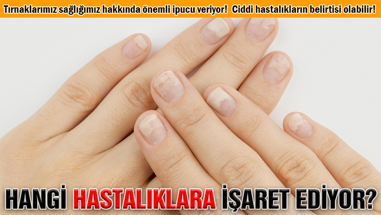 Tırnaklarda 8 önemli hastalık sinyali!